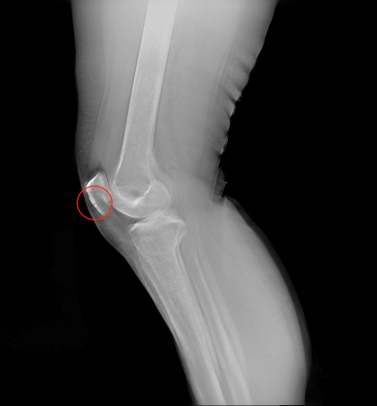 X-ray / Nanox.ARC comparison image of a patella