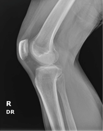 X-ray / Nanox.ARC comparison image of a patella
